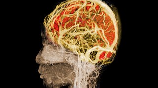 A little girl accidentally ate 96 * gummies, and this is what happened to her brain.