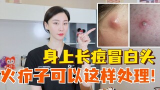 Jerawat dan komedo putih muncul di tubuh, bisul bisa ditangani seperti ini!