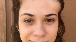 曾经患黑色素瘤皮肤癌的女孩，记录她的术后恢复过程