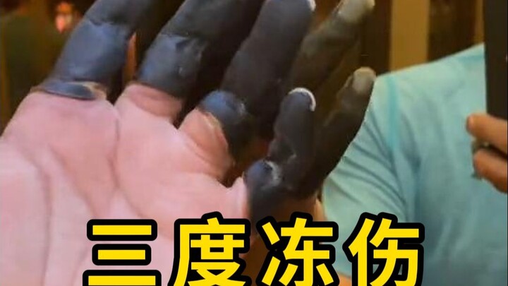 Bị tê cóng độ ba ở ngón tay vẫn đam mê leo núi!