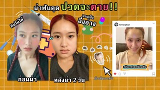 ประสบการณ์ผ่าฟันคุด ทรมานสุดๆ ปวดแทบตาย!!!!! บวมเป็นอึ่งอ่าง | SREIVPHOL