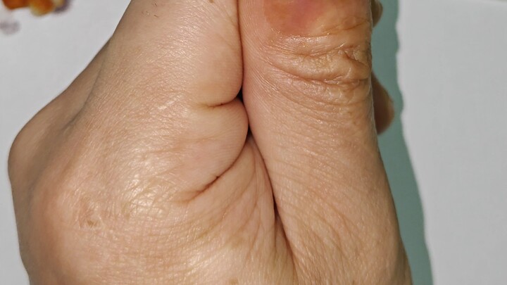 Paronikia, pengeluaran nanah