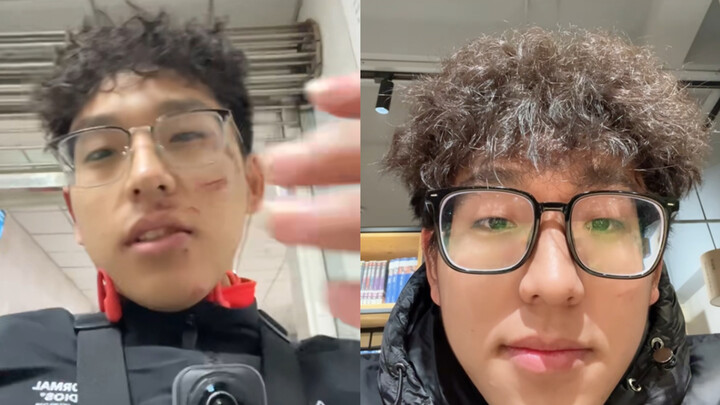 Kondisi Sebulan Setelah Jatuh dari Motor