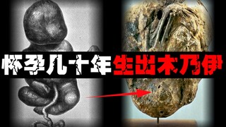 [Stone fetus] To protect the pregnant mother, the dead baby made such a reaction