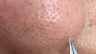 เป็นตรุษจีนและฉันมาที่นี่เพื่อดูคนอื่นกำจัดสิวหัวดำ