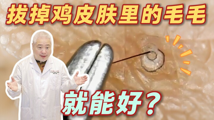【Giải đáp khoa học】 Những sợi lông bị tắc trong da gà, đúng là cứu tinh của hội ám ảnh sạch sẽ…