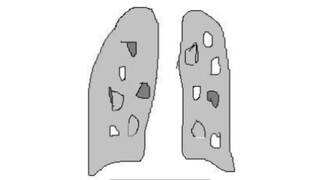 Signo extrapleural