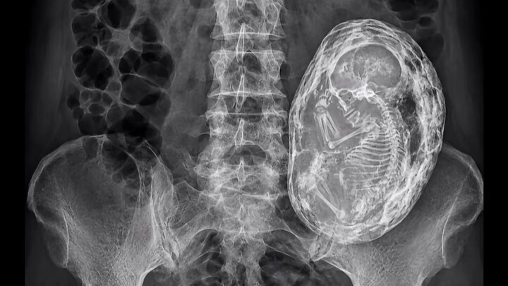 Seorang wanita merasakan benjolan di perutnya; setelah pemeriksaan foto, dokter sampai terkejut—tern