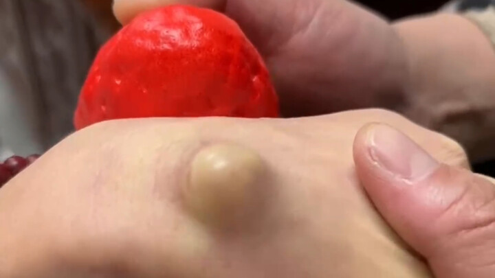 秒掉腱鞘囊肿