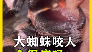 هناك من يقول إن لدغة العنكبوت لا تستطيع اختراق جلد الإنسان؟