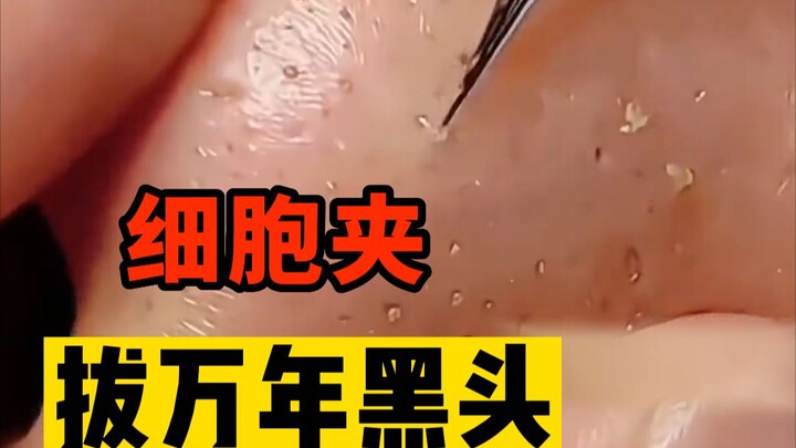 Cell‑clip blackhead removal is so stress‑relieving! This is how you should professionally get rid of