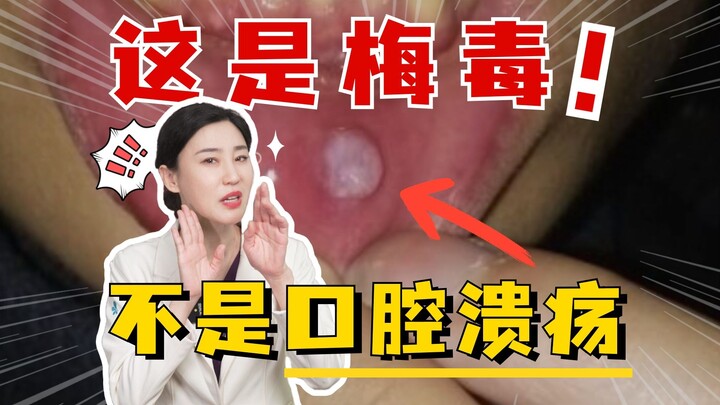 别再把梅毒硬下疳，错当成口腔溃疡了！