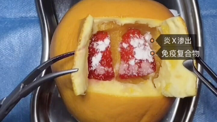 The ultimate COVID-19 treatment: ECMO, demonstrated with fruit by a caring doctor!