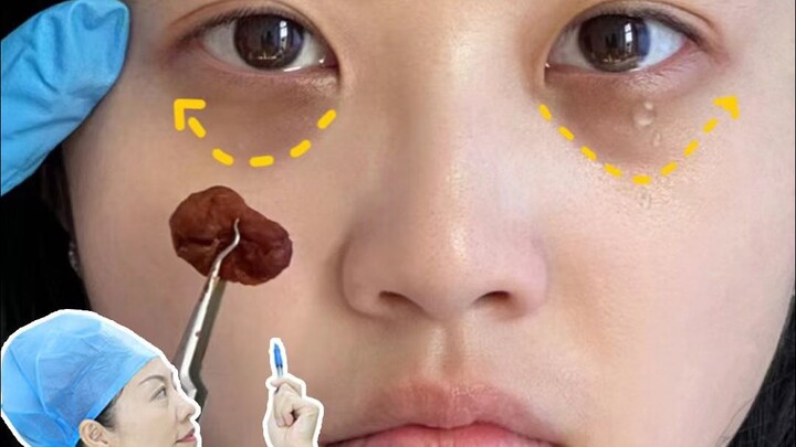 Bukan... lingkaran hitam karena begadang itu cuma gumpalan memar❓