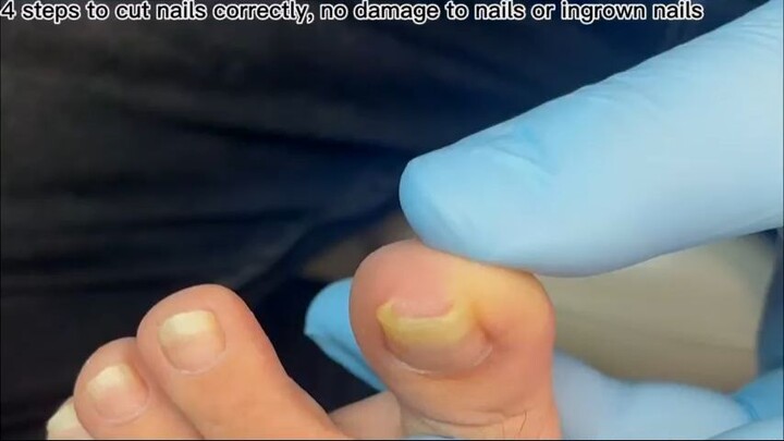 Repair severely deformed nails_R