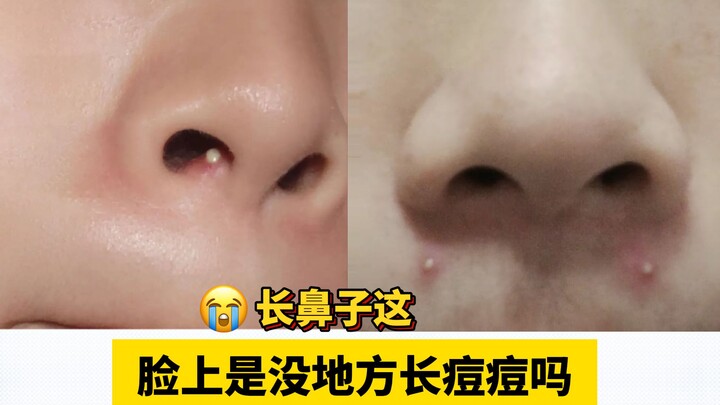 Đừng bao giờ nặn! Cách xử lý này cực kỳ đơn giản!