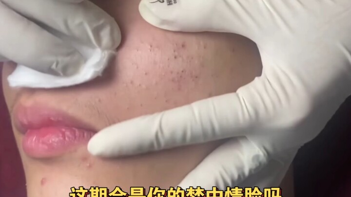 Nặn mụn đầu đen đến mức lau không kịp luôn