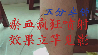 瘀血疯狂喷射五分半钟！（患者登门求诊，腿部刺血，当场轻松）