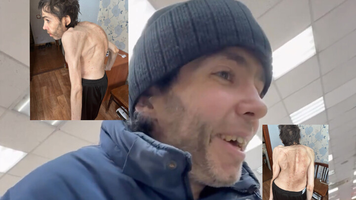 Helping Russia’s Poor Souls with Spinal Curvature (5)