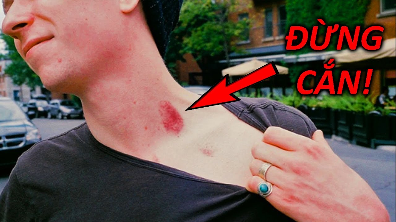 302 Yêu Nhau Đừng Cắn Chỗ Này!!! Hickey - Trò Nghịch Dại N.g.u.y ...