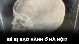 Bé gái chứa nhiều vật thể ở đầu đang gặp nguy kịch