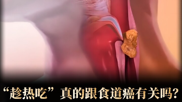 Is "Eat it while it's hot" really linked to esophageal cancer?