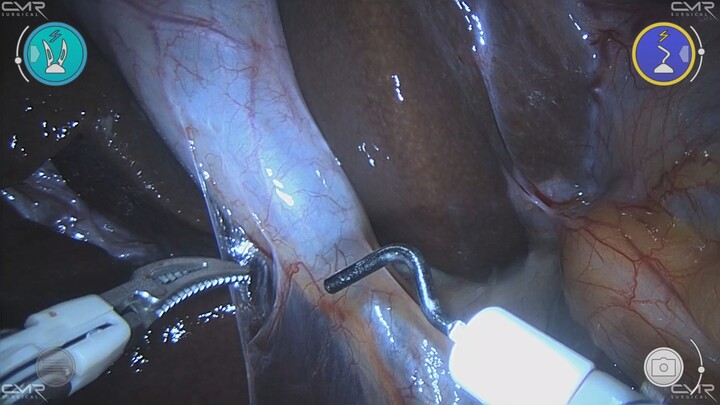 robotic cholecystectomy