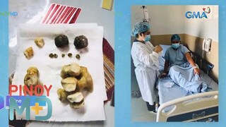 Labis na pag-inom ng softdrinks, sanhi ng pagkakaroon ng bato sa kidney | Pinoy MD