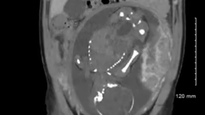 اكتشفت أنني حامل بعد إجراء الأشعة المقطعية!!