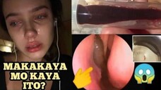 NANGANIB ANG BUHAY ng dalaga matapos matagpuan ang hayop na ito sa loob ng kanyang ilong