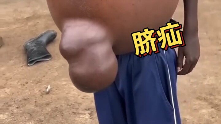 脐疝：肠管掉进肚脐里