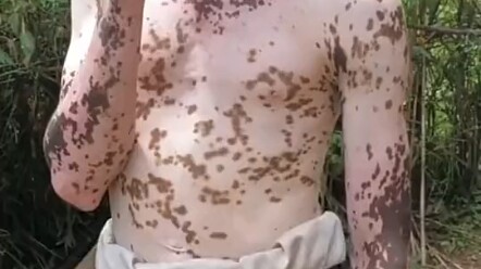 من أجل ذلك المسكين الذي يلحس الأحذية طلبًا للطعام، لا يتوانى الشاب الأسود عن التعرض لمرض البهاق.