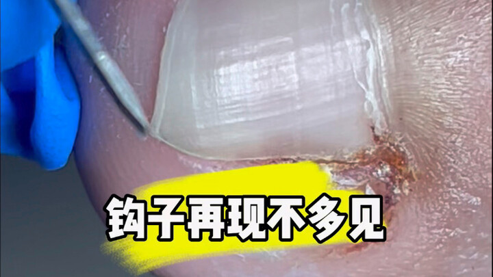 Hooks are rare these days.