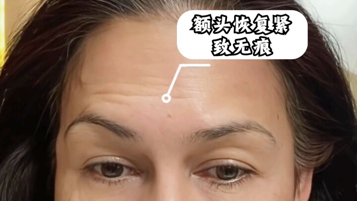 "跟着泰国女星 Vicky 曼谷打肉毒！新手必看除皱避坑指南"