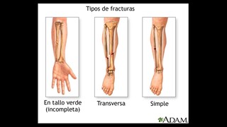 Cuadro sinóptico de las fractuas