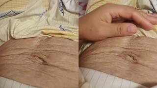女子生完娃一年满肚皱纹，皮肤松垮毫无弹性能直接提起，网友炸锅