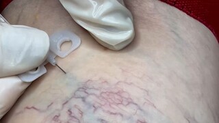 "Sclerotherapy" for treating spider veins and varicose veins. After the injection of sclerotherapy, 