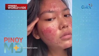 Solusyon para sa cystic acne, alamin! | Pinoy MD