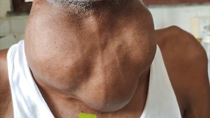 The largest thyroid goiter I've ever seen