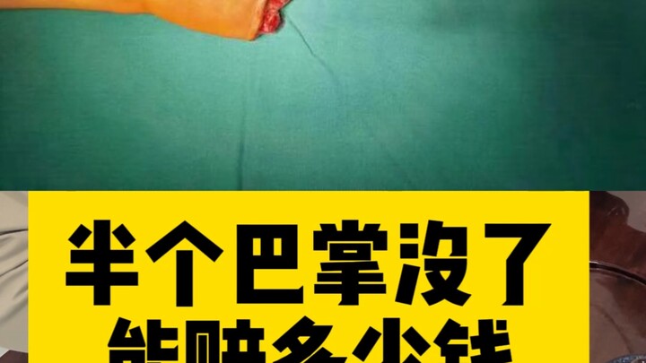 ถ้าฝ่ามือขาดไปครึ่งหนึ่ง จะได้ชดเชยเท่าไร?