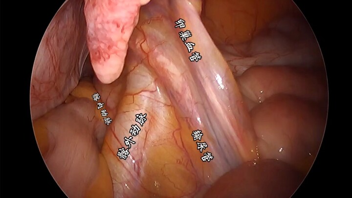 رؤية موضع الحالب بالمنظار البطني