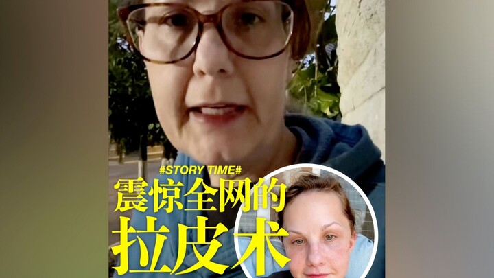 Operasi pengencangan wajah yang menggemparkan seluruh internet