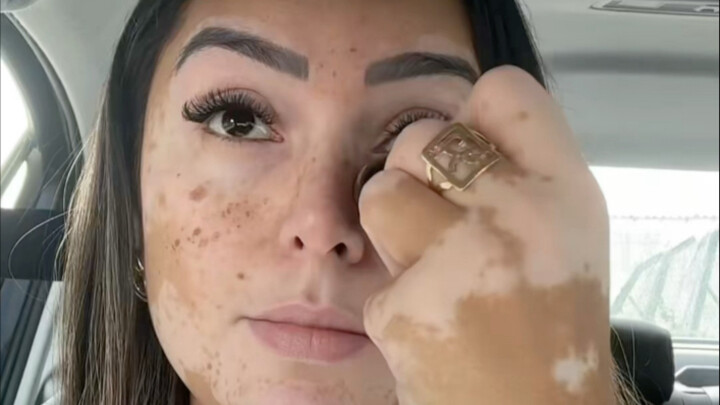 كيف تضع مرضى البهاق المكياج؟