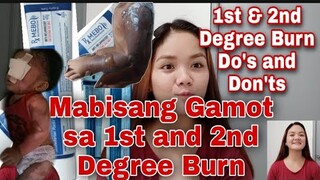 Mabisa na Gamot sa Paso | 1st and 2nd Degree Burn | Do's and Don'ts | Angelly's Tutorial