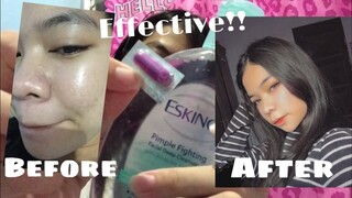 PAANO BA NAWALA NG MGA PIMPLES KO IN EASY WAY!! (SUPER EFFECTIVE)