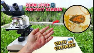 ZOOM 1000X: KUTU SCABIES