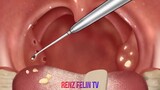 TONSIL AND SALIVARY STONE REMOVAL ADN TREATMENT