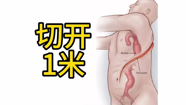 ผ่าเปิดแผลผ่าตัดยาว 1 เมตร เพื่อเปลี่ยนเส้นเลือดแดงใหญ่ทั้งหมด