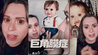 来了解一下巨角膜症