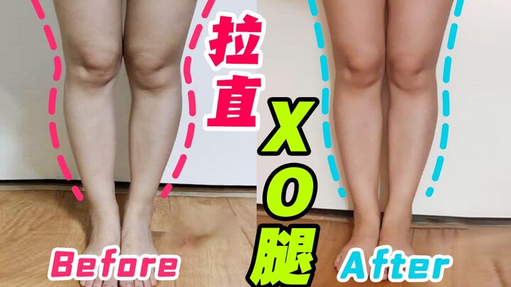 احذر! لا تفعل هذا أبدًا إذا كنت تعاني من تقوس الساقين من النوع XO – فكلما ركعت أكثر، زاد تقوس ساقيك!